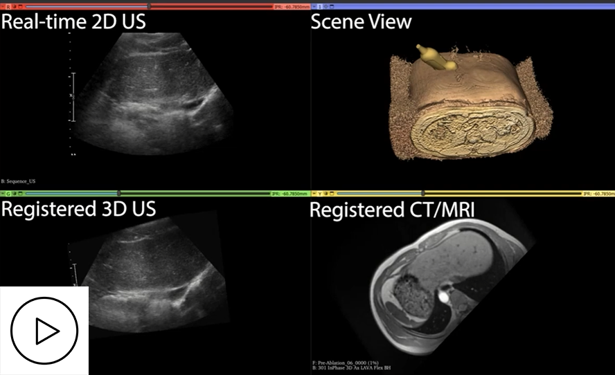 3DLIVUS registration: 2D US-to-CT/MRI