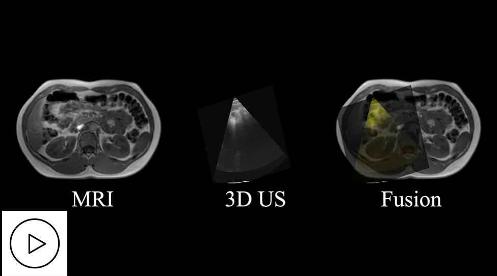 3DLIVUS registration: 3D US-to-CT/MRI