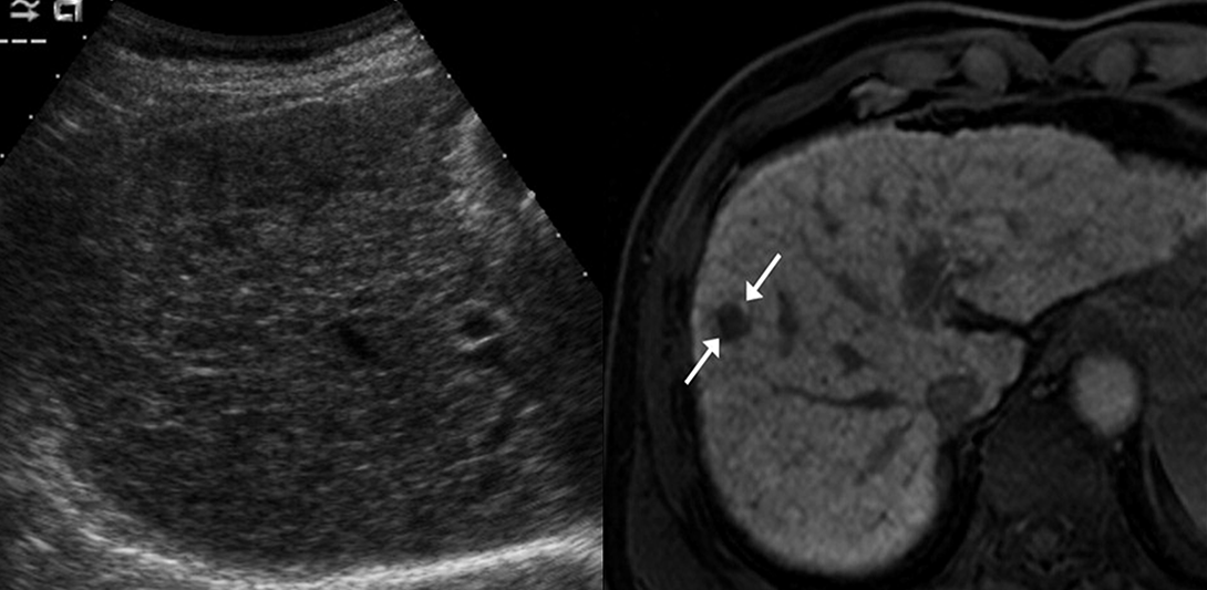 Invisible tumour 1