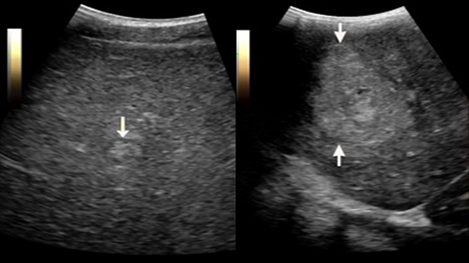 Invisible tumour 2